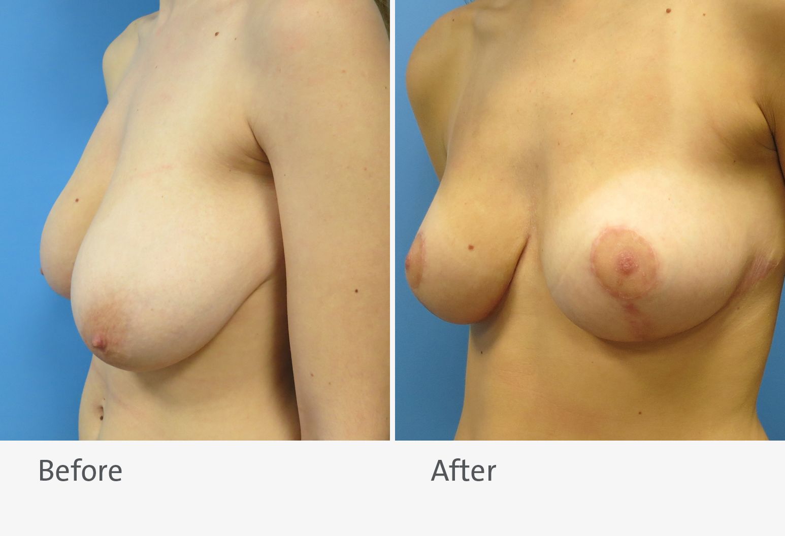 A patient is shown before and after a breast reduction. On the left is the patient before the surgery with slightly drooping breasts and on the right is the patient after surgery, with breasts that appear smaller with more forward facing nipples.